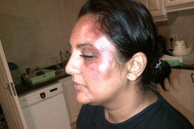 Zainub Priya Dala's injuries after she was was beaten with a brick.