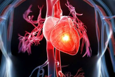 Cardiovascular diseases is a general term for conditions affecting the heart or blood vessels, usually associated with a build-up of fatty deposits in the arteries (atherosclerosis) and an increased risk of blood clots. (file photo).