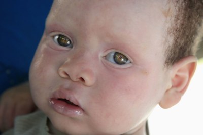 Un enfant atteint d’albinisme au Mozambique